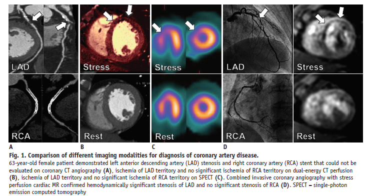 Ischemia miocardica e imaging cardiovascolare multimodale