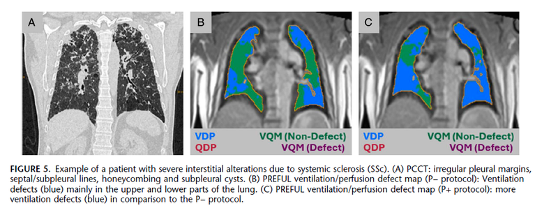 PREFUL – MRI e PCCT nelle pneumopatie infiltrative diffuse: il punto di vista del TSRM